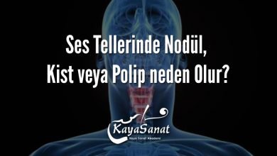 Ses Tellerinde Nodül, Kist veya Polip neden Olur?